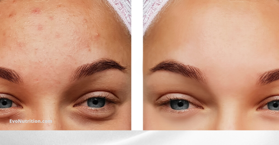 Does Apple Cider Vinegar Help Acne